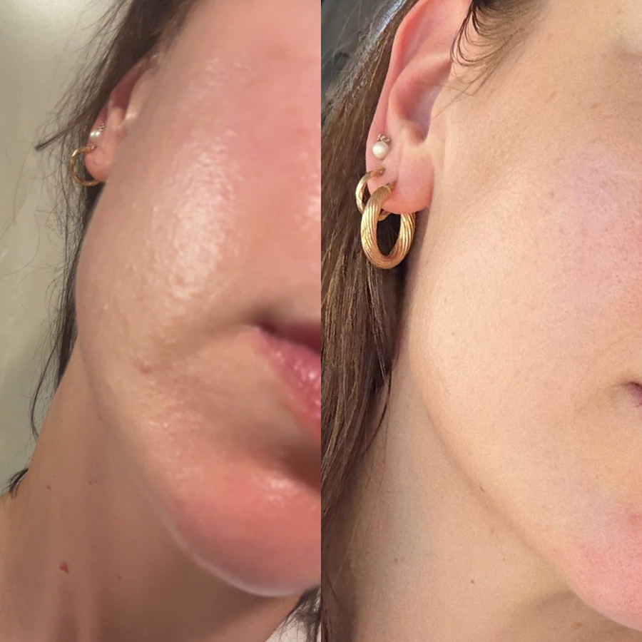 Renew - Chemical Peel Pads 100g | Chemical Peel | Reti Skin